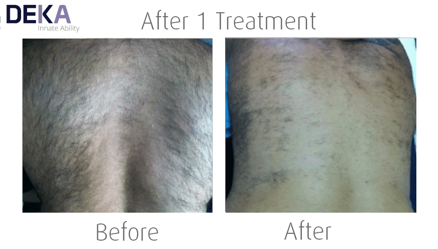 Laser Hair Removal for Men by Deka Motus Laser at The Spa Therapy Room